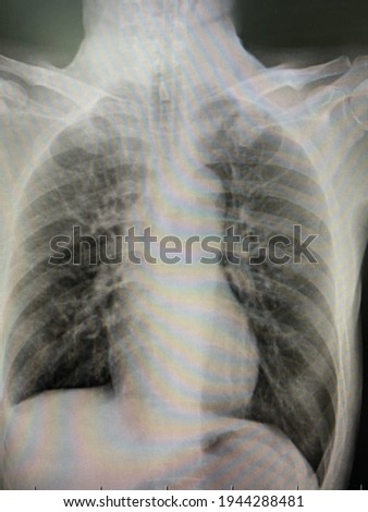 CXR P Lung case COPD