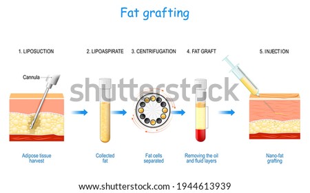 Fat grafting steps: from liposuction (adipose tissue harvest and Collected) to centrifugation for Fat cells separated, and Removing the oil and fluid layers for Nano-fat injection. Royalty-Free Stock Photo #1944613939