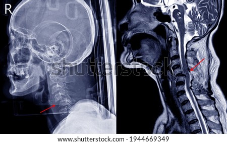 X-ray image and MRI of cervical spine case trauma showing C4,5 bilateral facet joint dislocation and facet fracture. The patient has complete spinal cord injury and paralysis of both legs.  Royalty-Free Stock Photo #1944669349