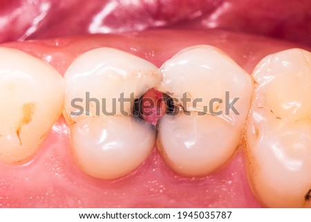 tooth no 14 and 15 with contact caries