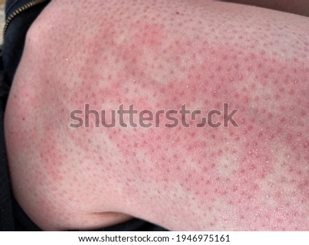 Hot Water Bottle Rash Stock Photos And Images Avopix Com