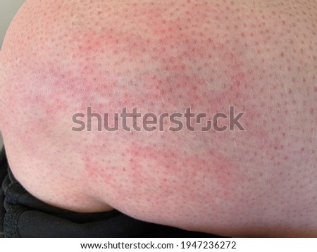 hives heat rash EAI Erythema ab igne heat reaction on knee close-up reference picture of blotchy red skin