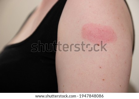 Arm of white woman 48 hours after receiving covid-19 coronovirus vaccination, showing swollen red reaction at the injection site Royalty-Free Stock Photo #1947848086