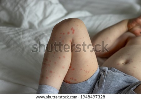 A toddler boy with rash infected by Roseola Disease. Roseola is a contagious illness that’s caused by a virus. It shows up as a fever followed by a signature skin rash. Royalty-Free Stock Photo #1948497328