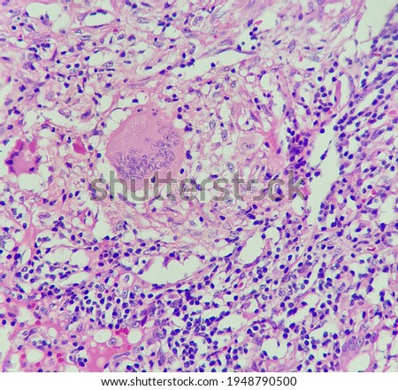 Photo of granuloma with multinucleated giant histiocytes, magnification 400x, photo under microscope Royalty-Free Stock Photo #1948790500