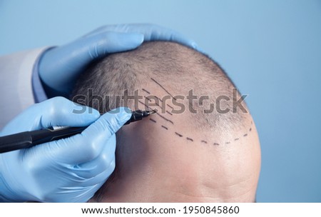 Patient suffering from hair loss in consultation with a doctor. Doctor using skin marker Royalty-Free Stock Photo #1950845860