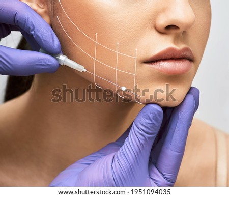 Facial lifting thread. Thread facelift with arrows on face for woman's skin, procedure facial contouring using mesothreads Royalty-Free Stock Photo #1951094035