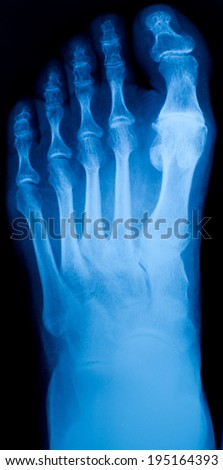 X-ray of the foot