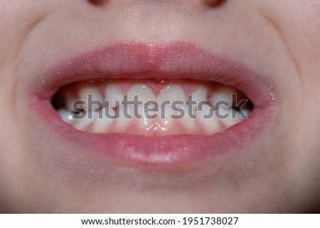 Malocclusion of a child, close-up on the front teeth of a child.