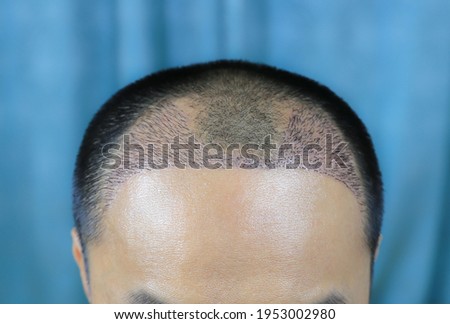 Close up top view of a man's head with hair transplant surgery with a receding hair line. -  After Bald head of hair loss treatment. Royalty-Free Stock Photo #1953002980