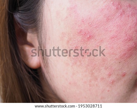 Red rash on young Asian Thai woman face, Itchy and allergic skin problems, dermatitis. Royalty-Free Stock Photo #1953028711