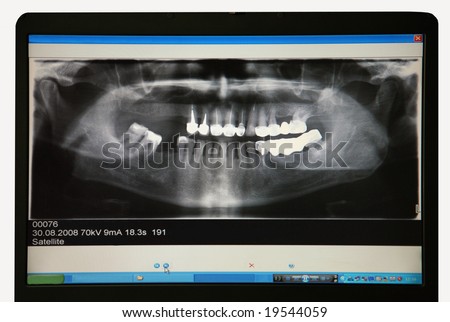 X-ray picture of a teeth of the person on the screen of the monitor of the computer