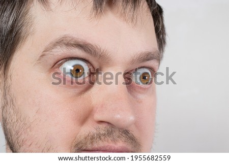 A pop-eyed man with Graves' disease toxic diffuse goiter, hyperthyroidism. Enlarged thyroid gland and exophthalmos bulging eyes. Endocrine system disease, endocrinology. Royalty-Free Stock Photo #1955682559