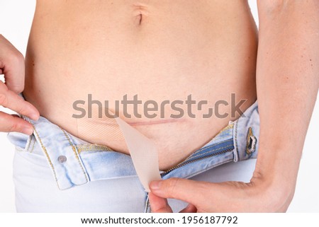 Woman is applying patch with a silicone sheeting on her scar after C-section surgery. Therapy for five months. Royalty-Free Stock Photo #1956187792