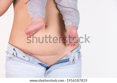 Close-up of a woman's belly with a cesarean section scar, five months after giving birth. Woman with a baby on her hand. C-section Royalty-Free Stock Photo #1956187819