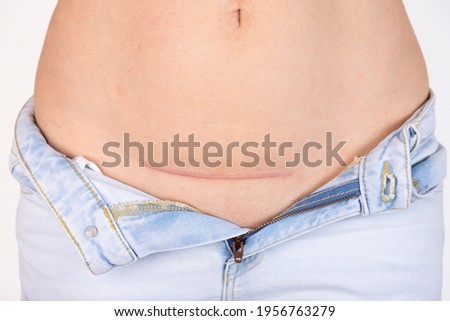 Woman's belly with a scar after cesarean section, childbirth. Five months after surgery. Royalty-Free Stock Photo #1956763279