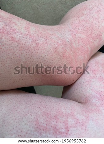 mottled skin heat rash hives allergy reaction on knee close-up reference picture of blotchy mottled red skin erythema ab igne also known as EAI this can also happen at end of life death 
 situations  Royalty-Free Stock Photo #1956955762
