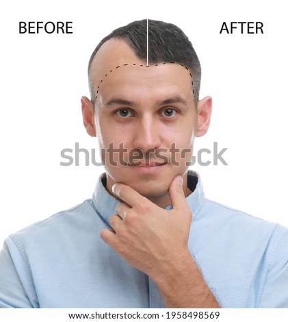 Man before and after hair loss treatment on white background, collage Royalty-Free Stock Photo #1958498569
