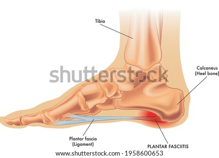 An illustration of the anatomy of a foot with the symptoms of plantar fasciitis. Royalty-Free Stock Photo #1958600653