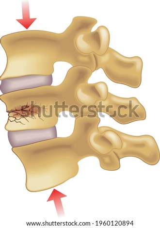 Medical illustration of the symptoms of vertebral compression fracture. Royalty-Free Stock Photo #1960120894