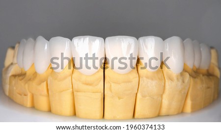 Beautiful upper teeth ceramic press veneers bleach of zircon arch prothesis Implants crowns. Dental restoration treatment clinic patient. Result of oral surgery procedure whitening dentistry Royalty-Free Stock Photo #1960374133