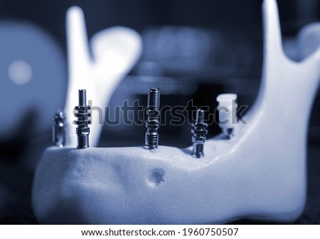 Titanium abutments in the artificial jawbone close-up. Royalty-Free Stock Photo #1960750507