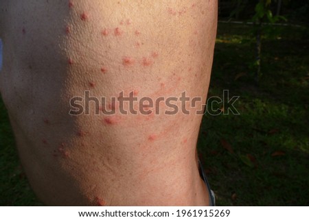 Bed bug bites marks on skin, Amazon rainforest near Marmori Lake, state of Amazon, Brazil.