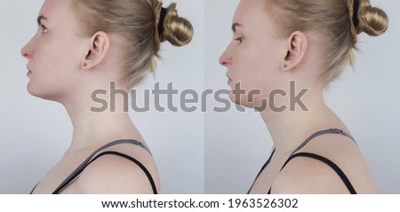 Before and after kyphosis. The woman suffers from a curvature of the spine in the upper section. The cervical vertebrae bulge out and form a hump. Curvature and incorrect posture treatment concept Royalty-Free Stock Photo #1963526302