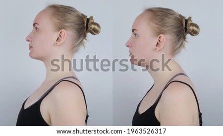 Before and after kyphosis. The woman suffers from a curvature of the spine in the upper section. The cervical vertebrae bulge out and form a hump. Curvature and incorrect posture treatment concept Royalty-Free Stock Photo #1963526317