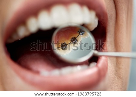 Close-up of female patient having check-up of dental braces on the back side of her teeth at dental clinic. Royalty-Free Stock Photo #1963795723