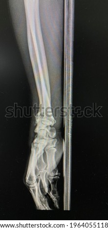 The picture of flim x-ray left hand  of patient who have distal end radius fracture,Medical Technology and Science concept.