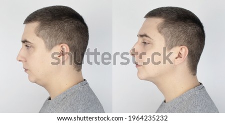 Double chin lift. Before and after plastic surgery, mentoplasty or face-building. Chin fat removal and facial contour correction. Concept of modern medicine and changes in body contours. Facelift Royalty-Free Stock Photo #1964235232