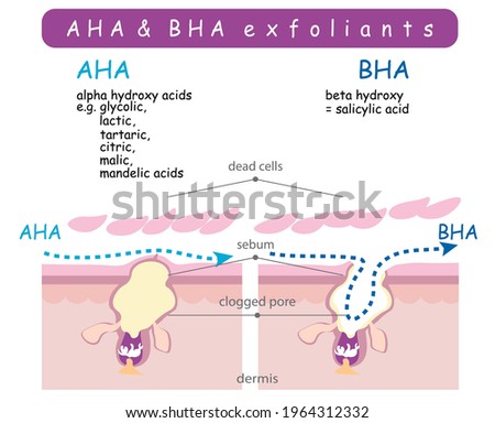 Vector info graphic shows difference of exfoliants. Scheme compare how AHA and BHA acids work with dead cells sebum lipid layer. Clogged pore inflammation peeling scientific anatomy poster. Clean skin Royalty-Free Stock Photo #1964312332