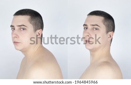 Before and after kyphosis. The man suffers from a curvature of the spine in the upper section. The cervical vertebrae bulge out and form a hump. Curvature and incorrect posture treatment concept Royalty-Free Stock Photo #1964845966