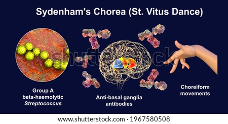 Sydenham's chorea, an autoimmune disease that results from Streptococcus infection, formation of anti-neuronal antibodies damaging brain basal ganglia that cause involuntary movements, 3D illustration