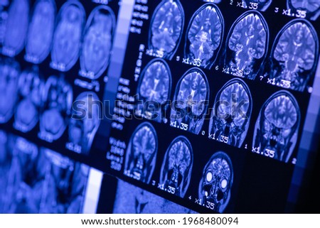 MRI of  brain of a healthy person with blue illumination. Magnetic resonance scan. Medical healthcare concept Royalty-Free Stock Photo #1968480094