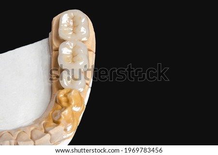 ceramic dental bridge for molars and premolars. on a black background. copy space