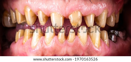 teeth preparations for ceramic veneers