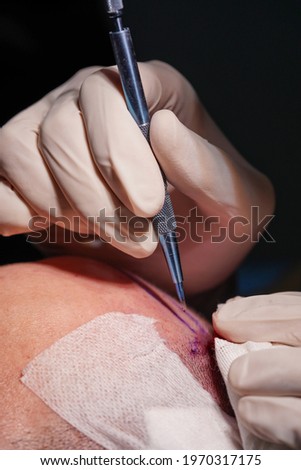 HAIR TRANSPLANT - FUE - SAPPPHIRE TECHNIQUE Royalty-Free Stock Photo #1970317175