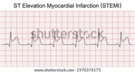 Electrocardiogram show ST elevation myocardial infarction (STEMI) pattern. Heart attack. Ischemic. Coronary artery disease. Angina pectoris. Chest pain. ECG. EKG. Medical health care. Royalty-Free Stock Photo #1970376173