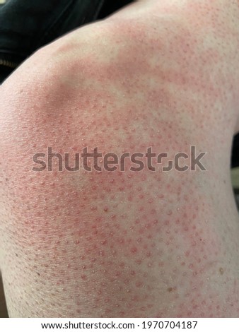 mottled skin heat rash hives allergy reaction on knee close-up reference picture of blotchy mottled red skin erythema ab igne also known as EAI this can also happen at end of life situations 
