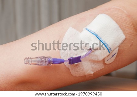 Picc (Peripherally Inserted Central Catheter) in the arm of a young woman. Picc can be used for long-term chemotherapy, antibiotic therapy, or total parenteral nutrition. Royalty-Free Stock Photo #1970999450