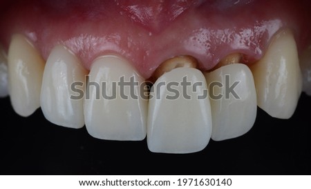 Placing all ceramic crown to mask darken teeth for esthetic reason, All ceramic zirconia crowns were placed in the mouth to whiten the smile. Royalty-Free Stock Photo #1971630140