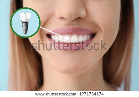 Young woman with implanted teeth, closeup Royalty-Free Stock Photo #1971734174