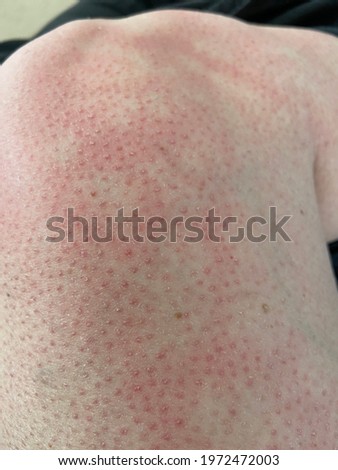heat rash hives allergy reaction on knee close-up reference picture of blotchy mottled red skin erythema ab igne also known as EAI