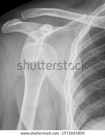 anterior shoulder dislocation xray bone Royalty-Free Stock Photo #1972685804