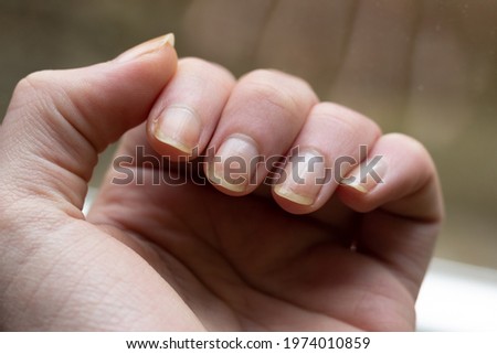 Damaged yellow fingernails .
Chipped nails. Royalty-Free Stock Photo #1974010859