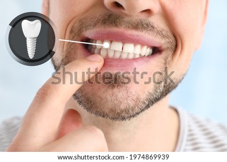Man showing implanted teeth on light background, closeup Royalty-Free Stock Photo #1974869939
