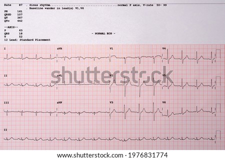 Images charts scientific cardiograms, and mathematical calculations from patients. Heart pulse or Heart wave, graph on paper.(Electrocardiography: ECG) Royalty-Free Stock Photo #1976831774