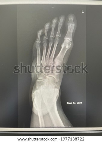 X-ray film of human left foot no fragments with label L to explain side of foot